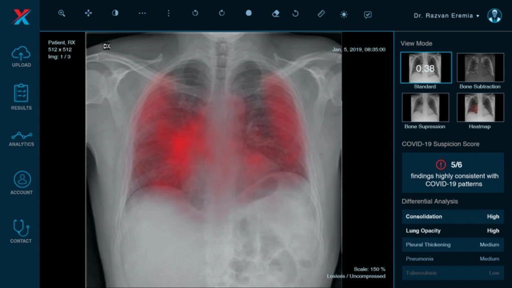 Xvision, care foloseşte AI pentru analiza radiografiilor, a început să scaneză pacienţi suspecţi de COVID 19 din Capitală şi Timişoara