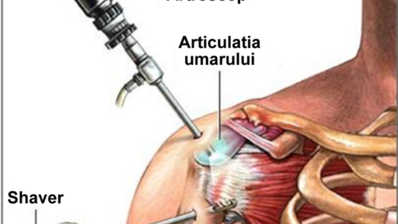 sindromul_de_impingement_al_umarului_1_74341500
