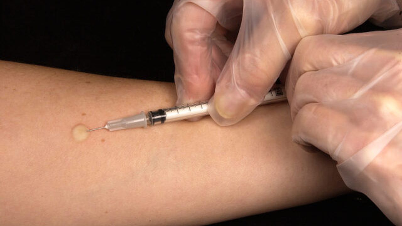 mantoux_tuberculin_skin_test_63889200