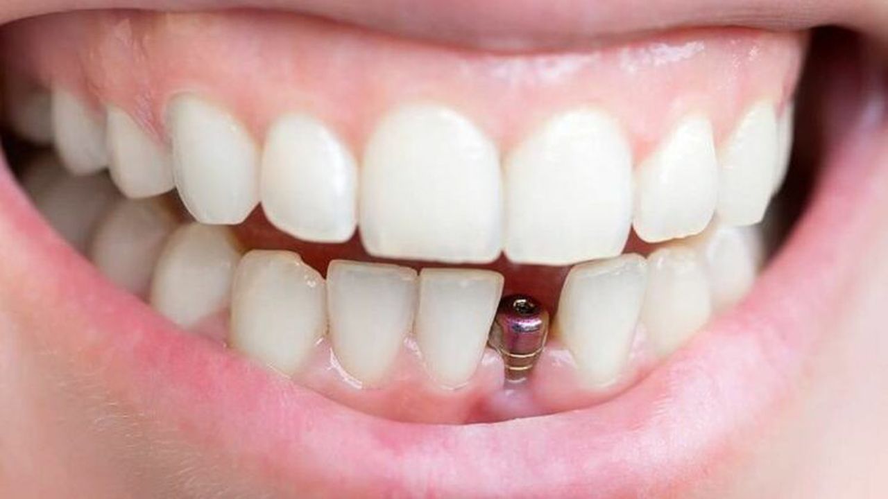 motive_pentru_alegerea_implanturilor_dentare_73857200