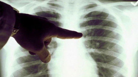 Tuberculoza rămâne, după COVID-19, a doua boală infecţioasă cu consecinţe fatale în Europa şi Asia Centrală