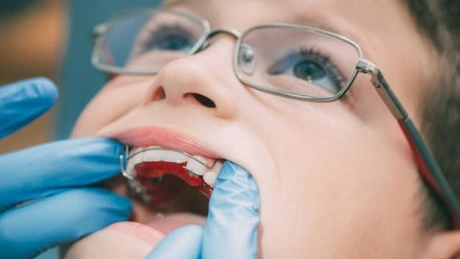 Vouchere pentru elevi în vederea montării de aparate ortodontice mobile - proiect adoptat de CGMB