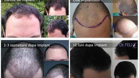 Vă interesează prețul pentru un implant de păr? Aflați detalii chiar aici (P)